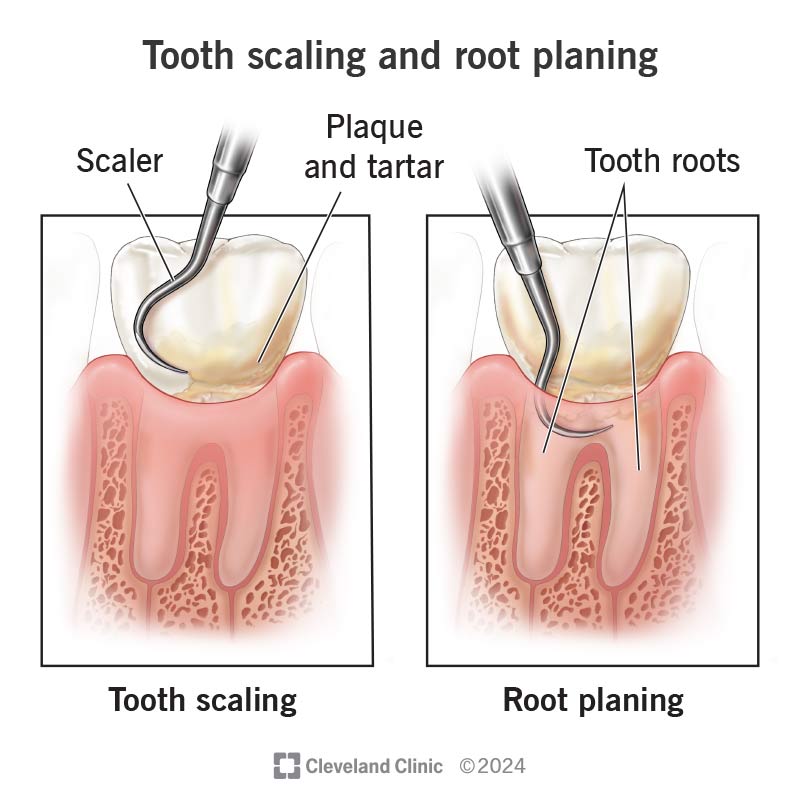 Scaling and root planing, illustrative dental-care visual