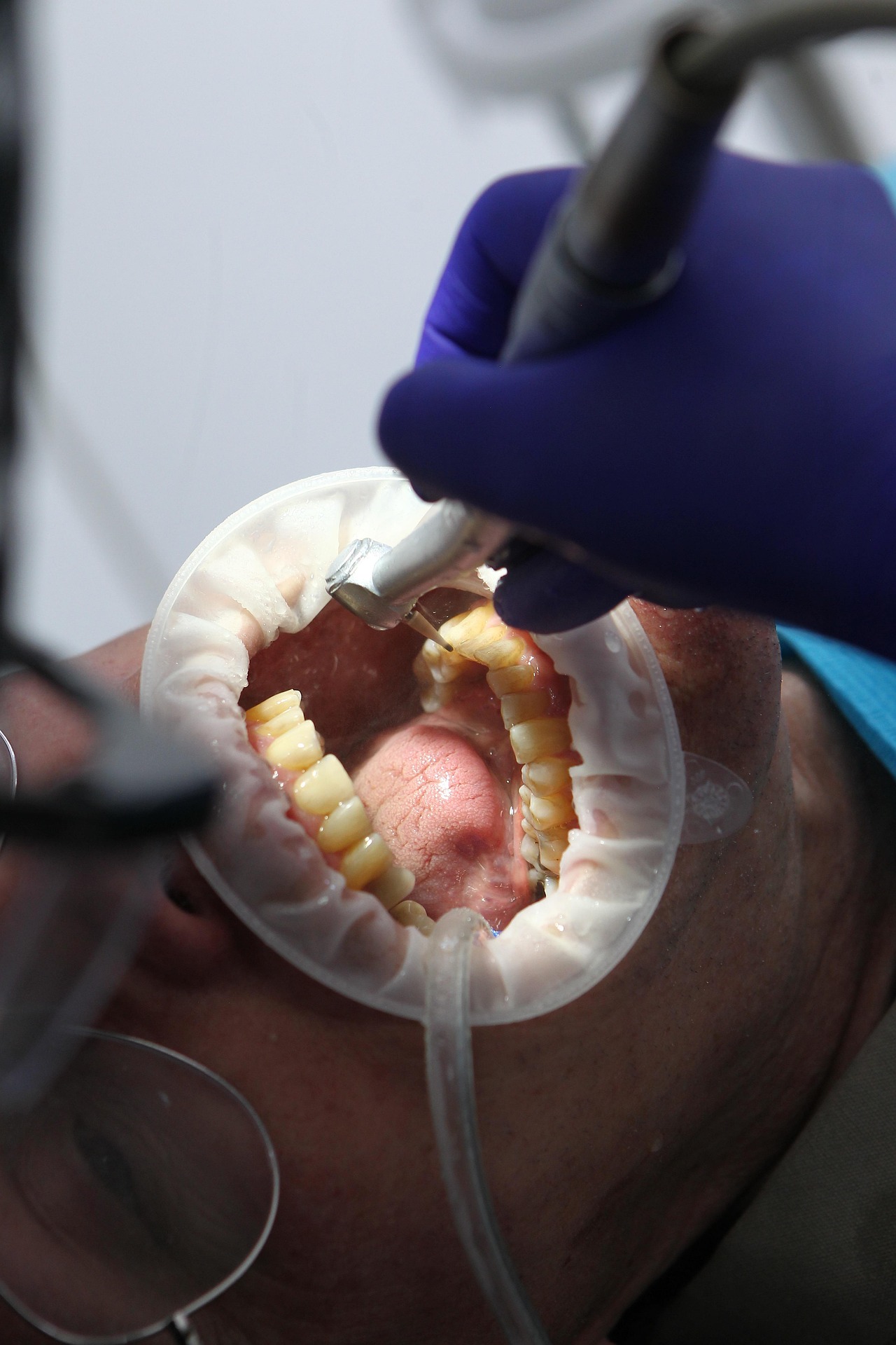 Illustrative image of Tooth-Coloured Fillings