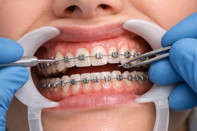 Illustrative image of Braces (Metal & Ceramic)