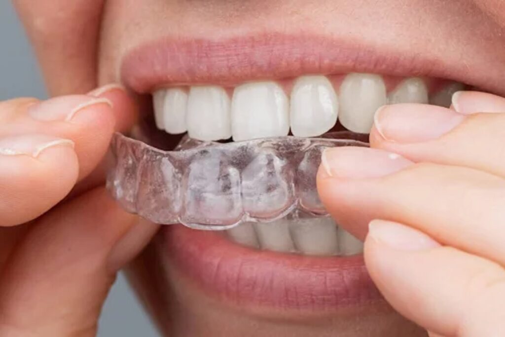 Clear aligners, illustrative dental-care visual