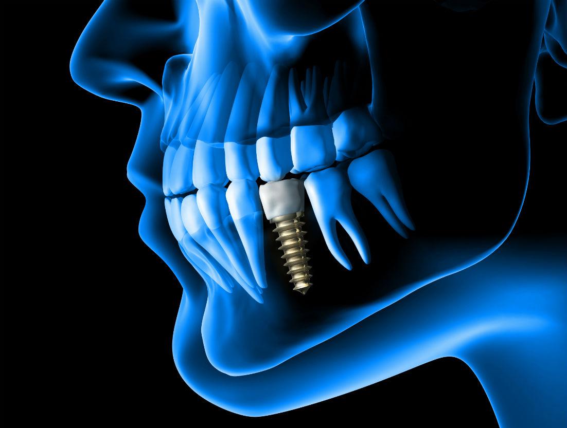Implant illustration, illustrative dental-care visual
