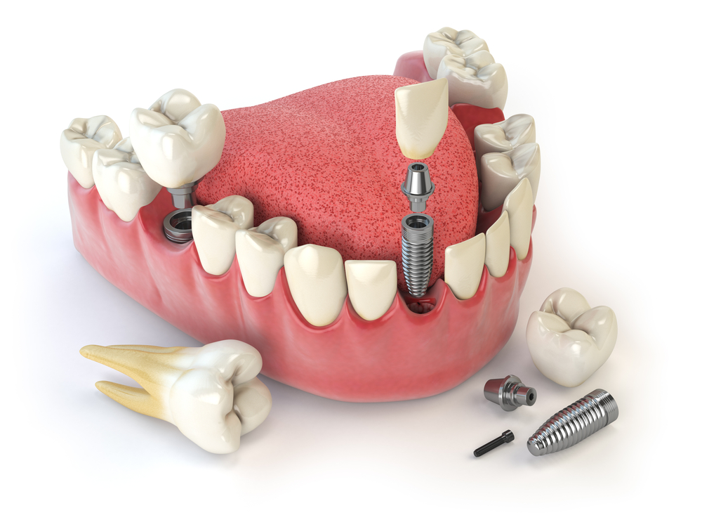 Dental implant model, illustrative dental-care visual